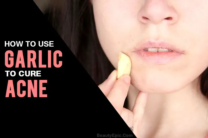 garlic for acne