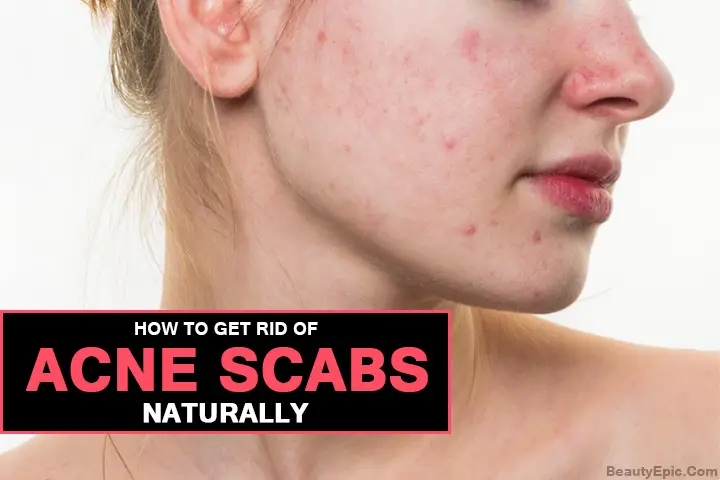 how to get rid of acne scabs