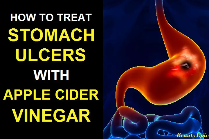 apple cider vinegar for ulcers