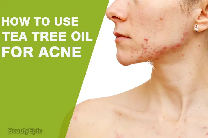 tea tree oil for acne