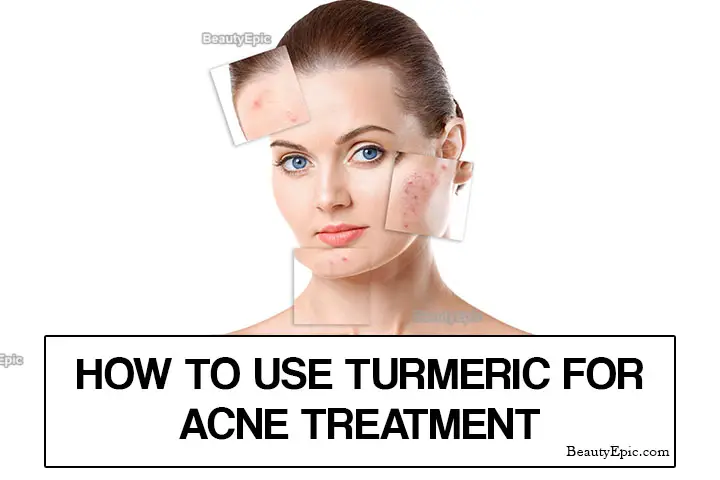 turmeric for acne treatment