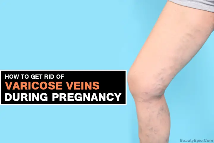 varicose veins during pregnancy