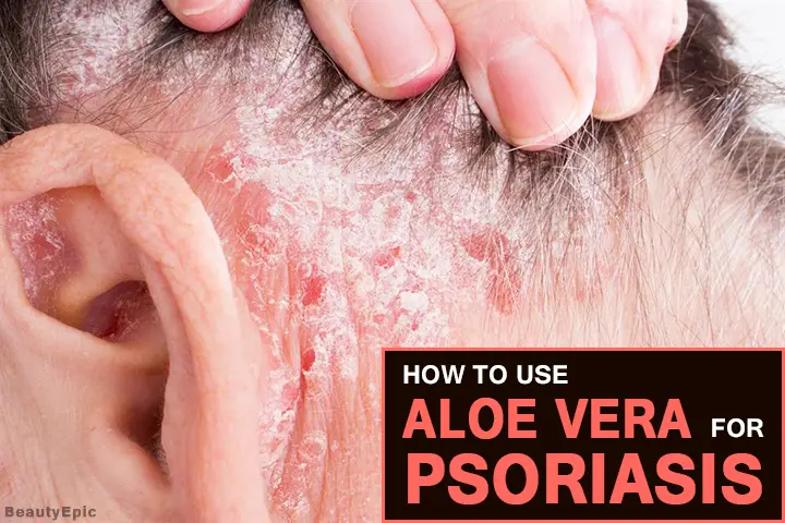 aloe vera for psoriasis