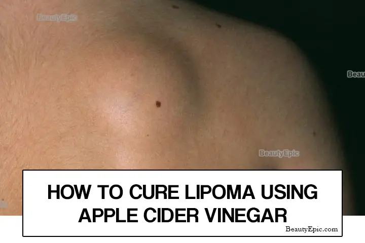 apple cider vinegar for lipoma treatment