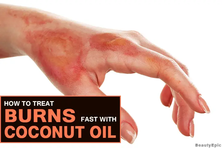 coconut oil for burns