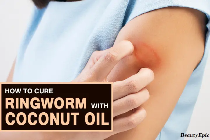 coconut oil for ringworm