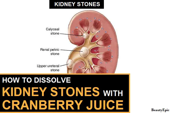 cranberry juice for kidney stones