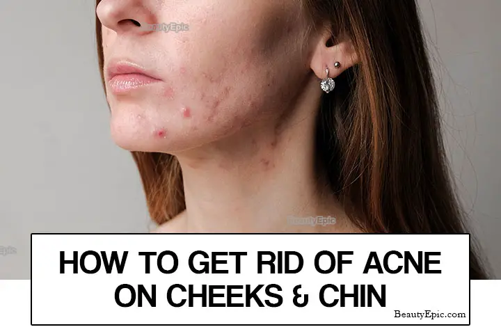 how to treat acne on cheeks and chin