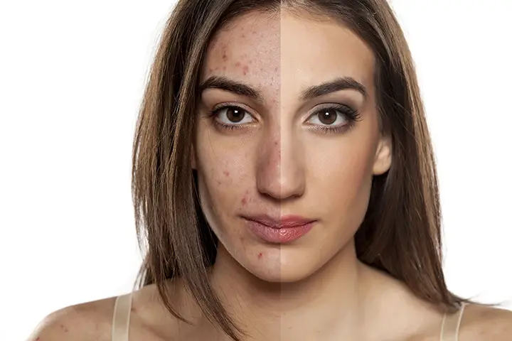 how to use turmeric for acne scars