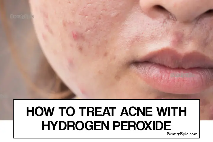 hydrogen peroxide for acne treatment