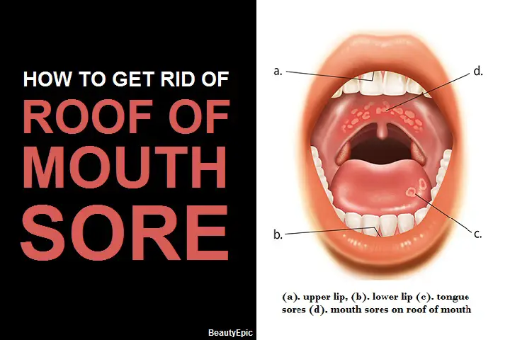 roof of mouth sore