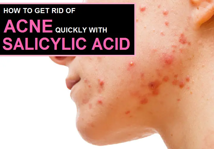 How to Use Salicylic Acid for Acne?