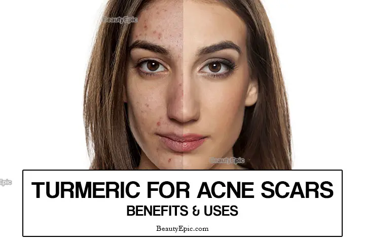 turmeric for acne scars