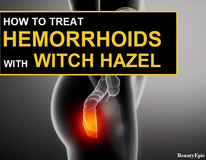witch hazel for hemorrhoids