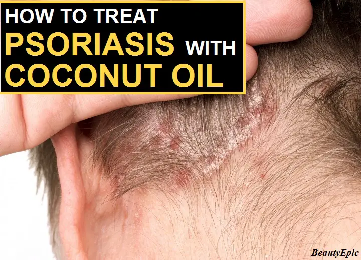 coconut oil for psoriasis