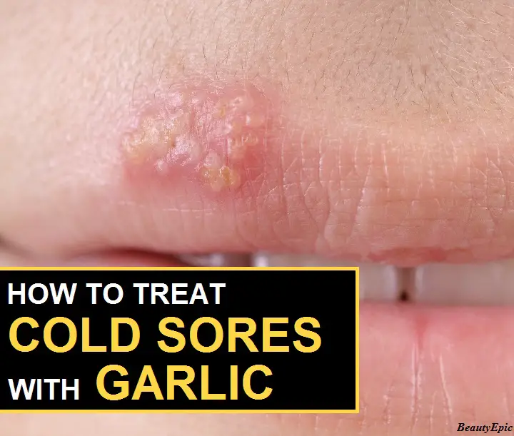 garlic for cold sores