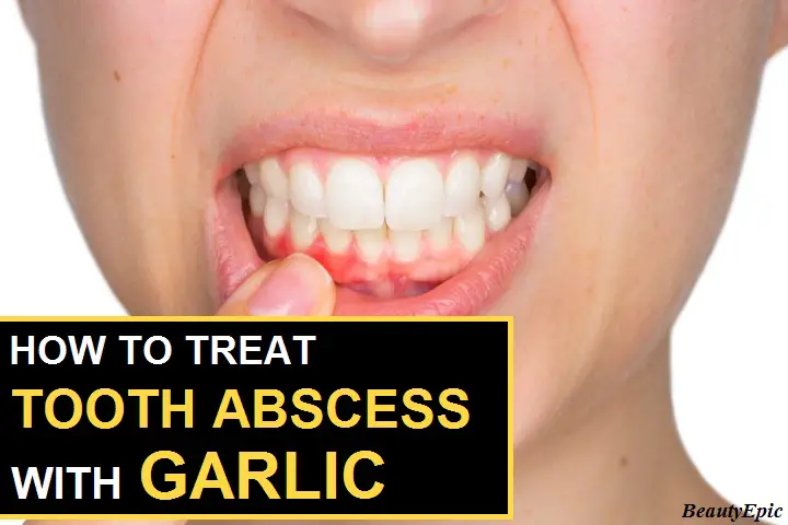 garlic for tooth abscess