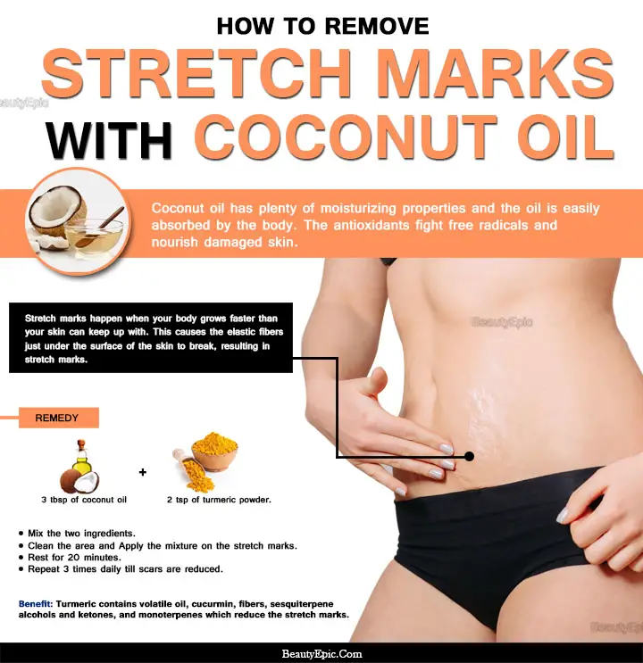 coconut oil for stretch marks