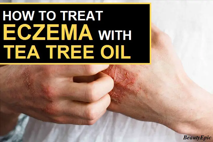 tea tree oil for eczema