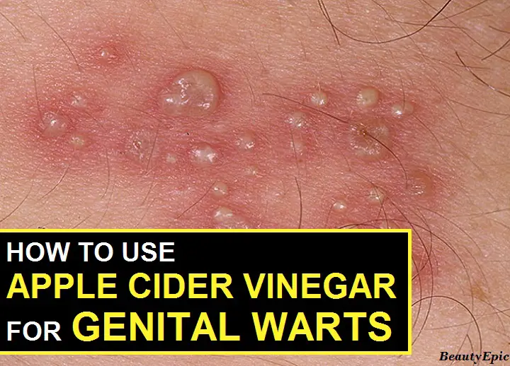 apple cider vinegar for genital warts