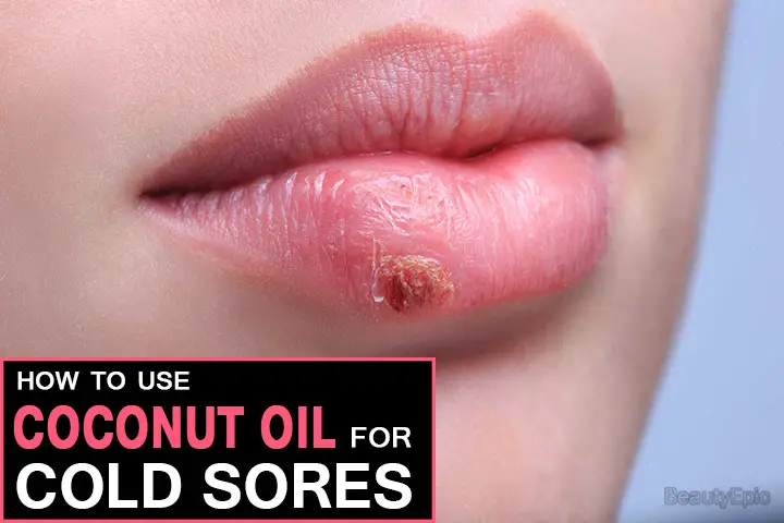 coconut oil for cold sores