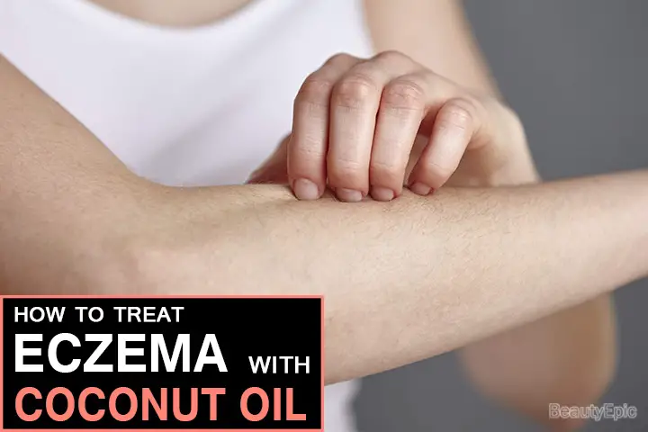 coconut oil for eczema