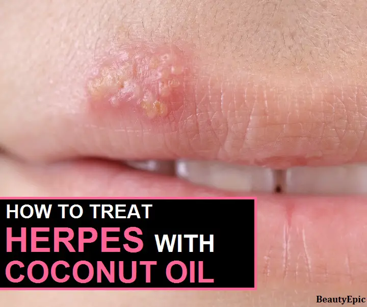 coconut oil for herpes
