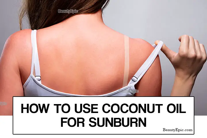 coconut oil for sunburn relief