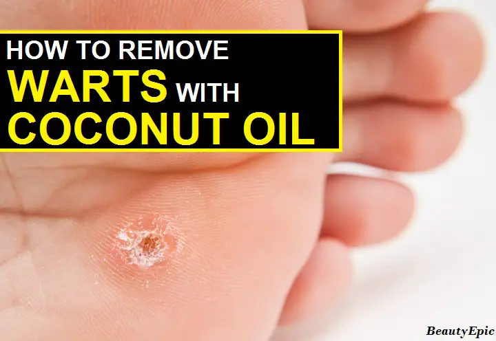 coconut oil for warts