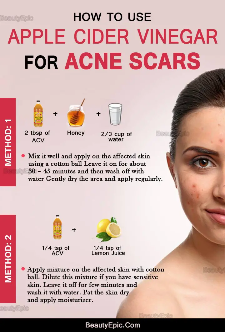 how to use apple cider vinegar for acne scars