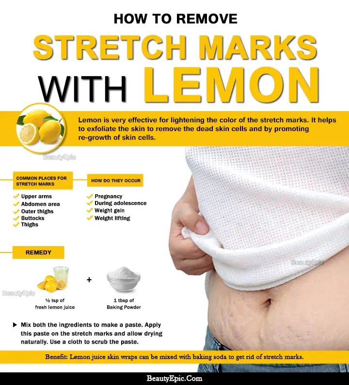 lemon for stretch marks