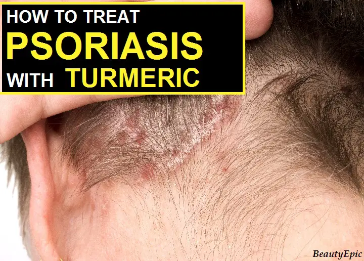 turmeric for psoriasis