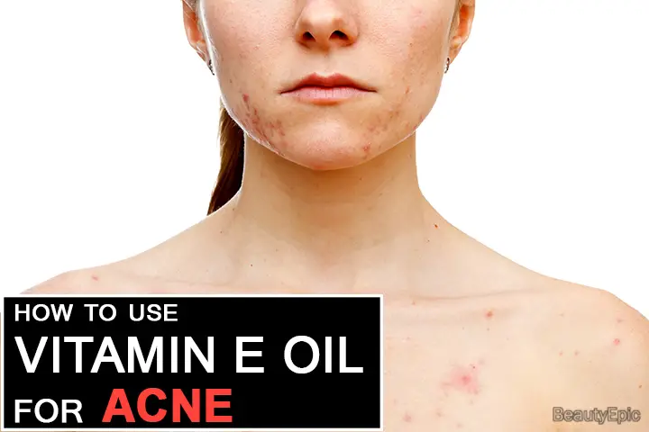 vitamin e oil for acne