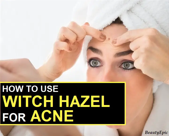 witch hazel for acne