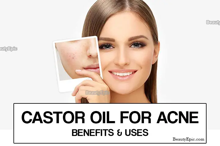 castor oil for acne