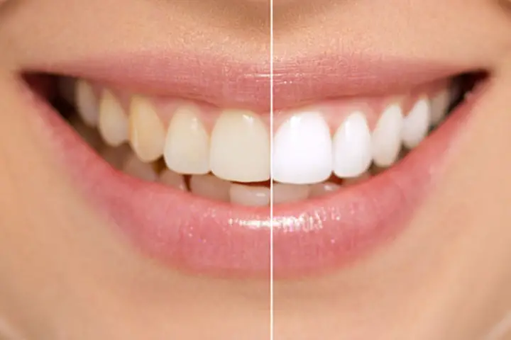 how to use baking soda for teeth whitening