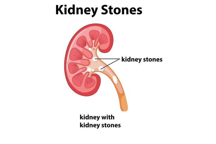 lemon juice for kidney stones