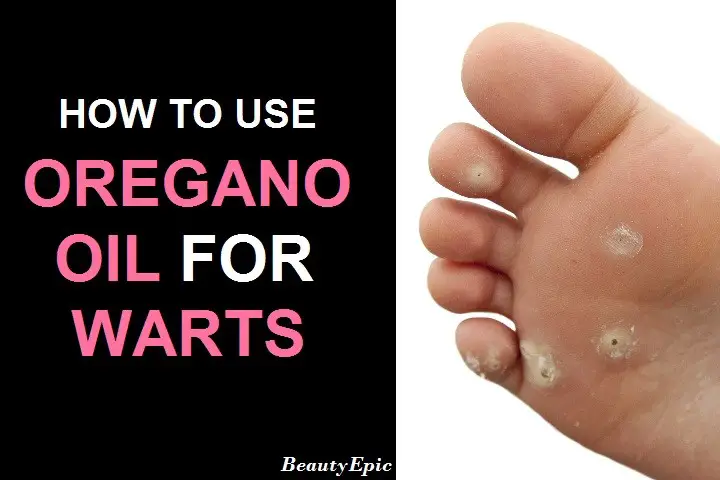 oregano oil for warts