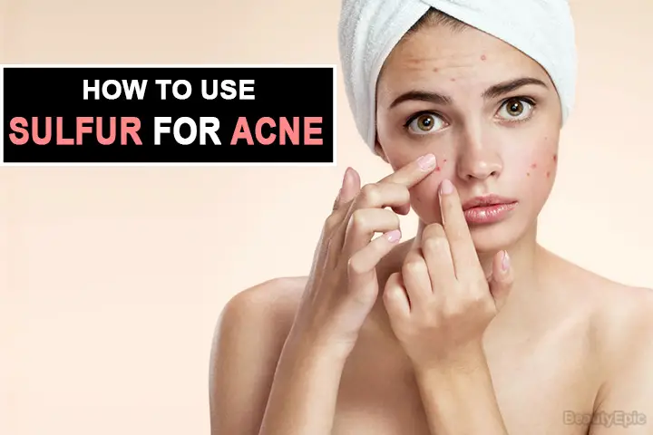 sulfur for acne