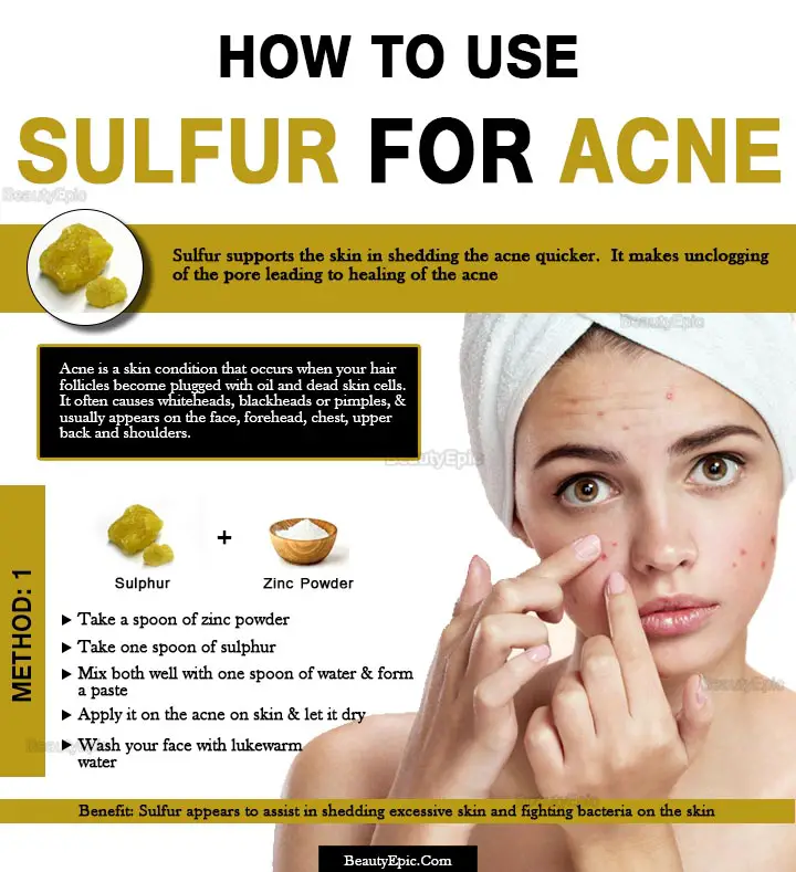 sulfur for acne