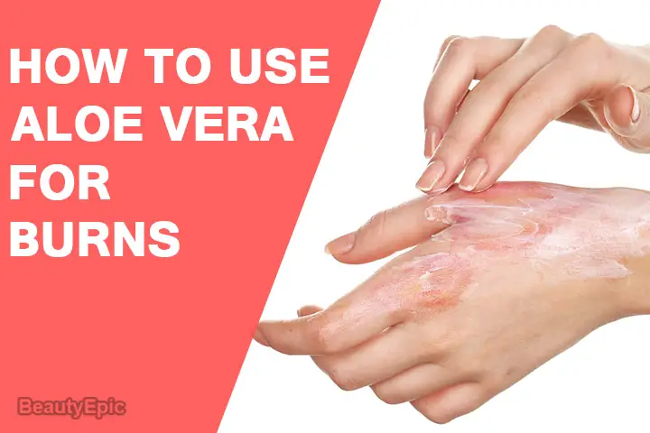 aloe vera for burns