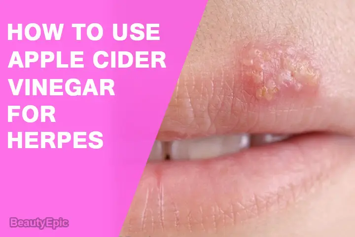 apple cider vinegar for herpes