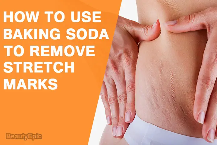 baking soda for stretch marks