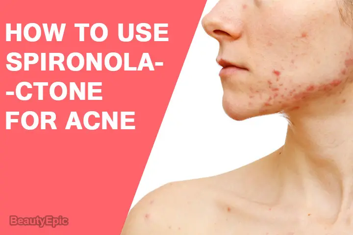 spironolactone for acne