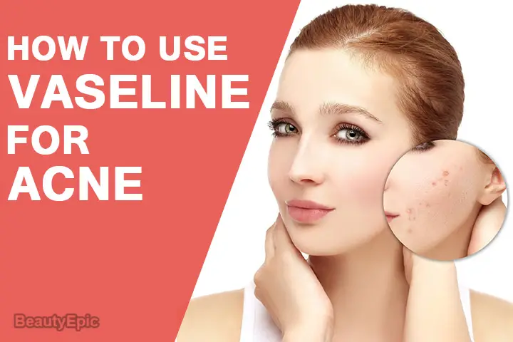 vaseline for acne