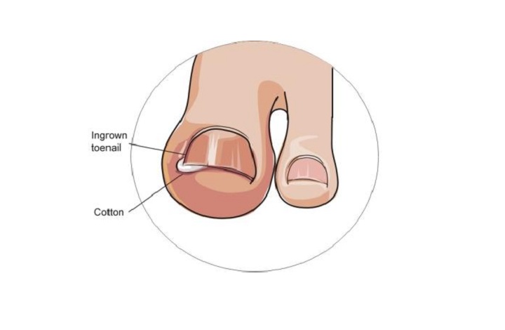 cotton under ingrown toenail