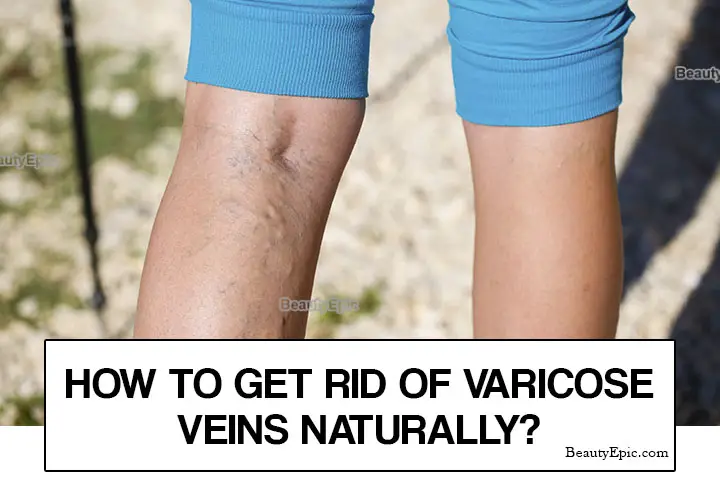get rid of varicose veins
