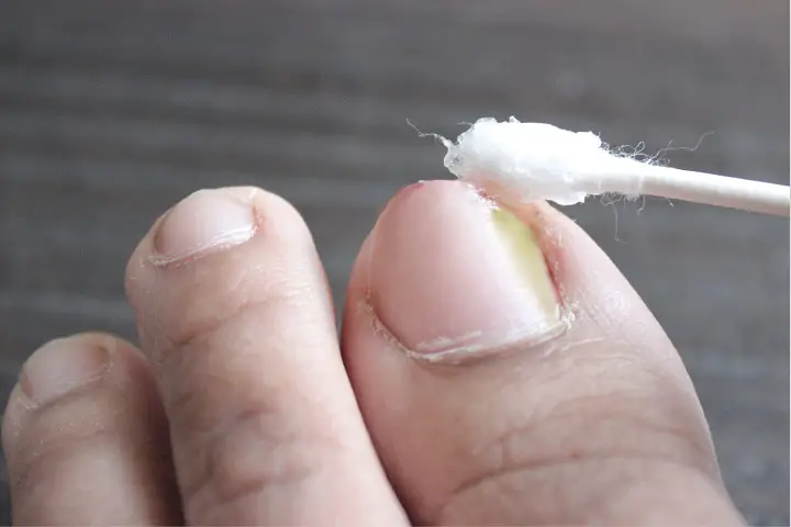 tea tree oil for ingrown toenail