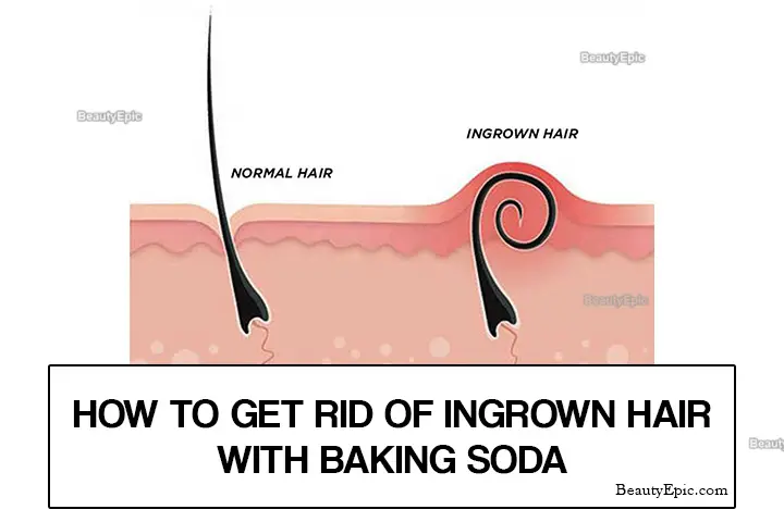 baking soda for ingrown hair