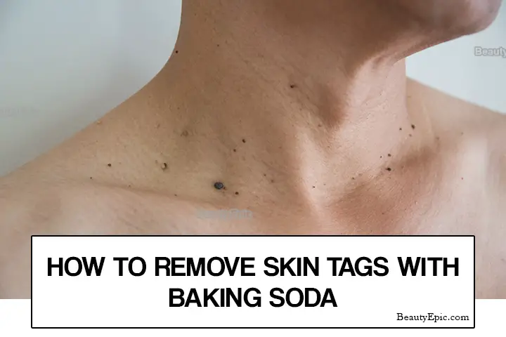 baking soda for skin tags